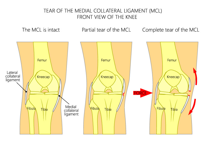 MCL Injuries Surgeries