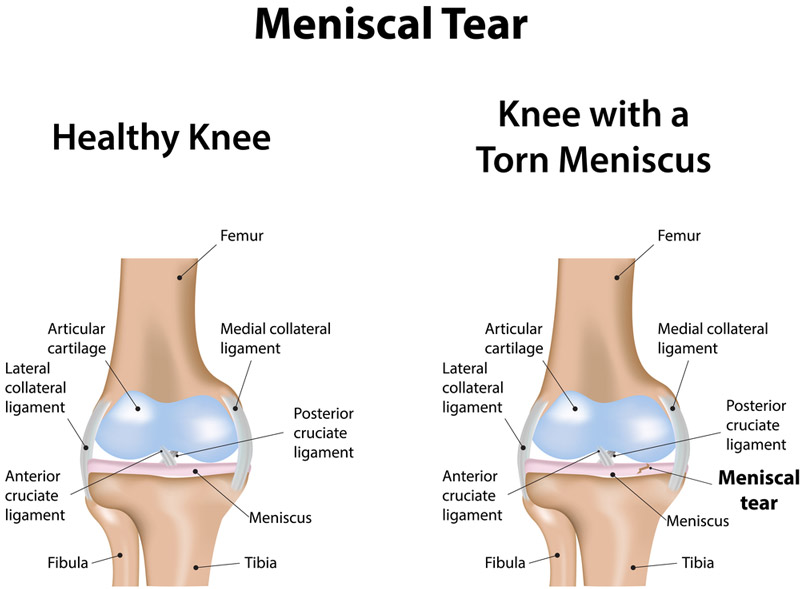 Meniscus Pain Repair