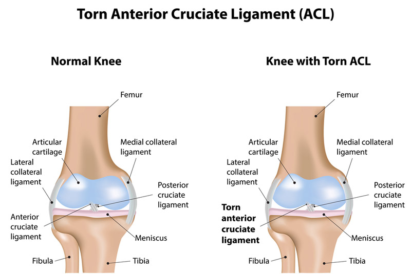 Acl and mcl surgery
